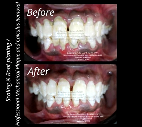 Scaling & Root Planing Case Result