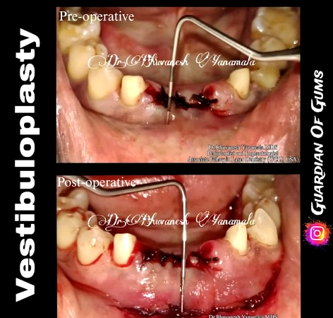 Laser Gum Surgery Case Result
