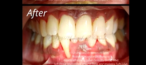 Smile Makeover After Treatment