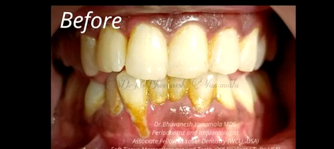 Smile Makeover Before Treatment